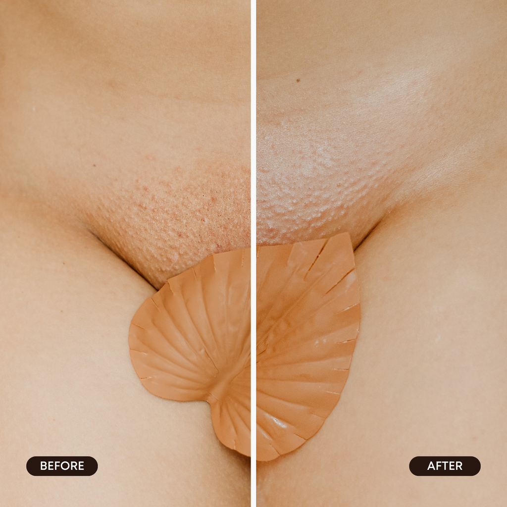 Hydrogel Vajacial Side Strips