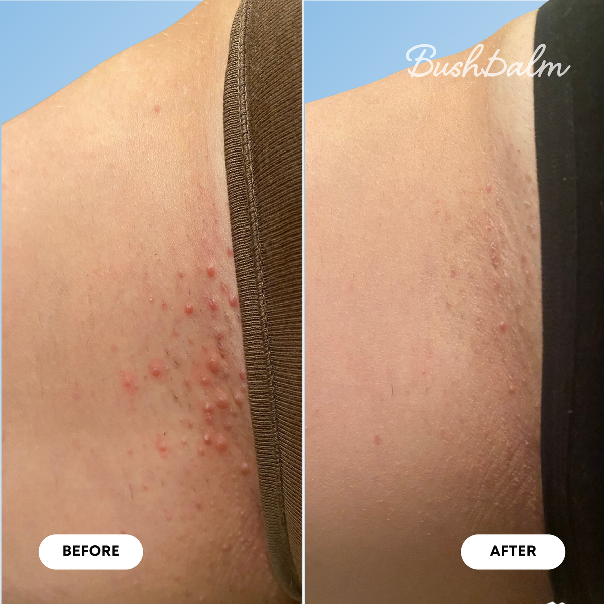 Mini Ingrown Hair Oil - Nude