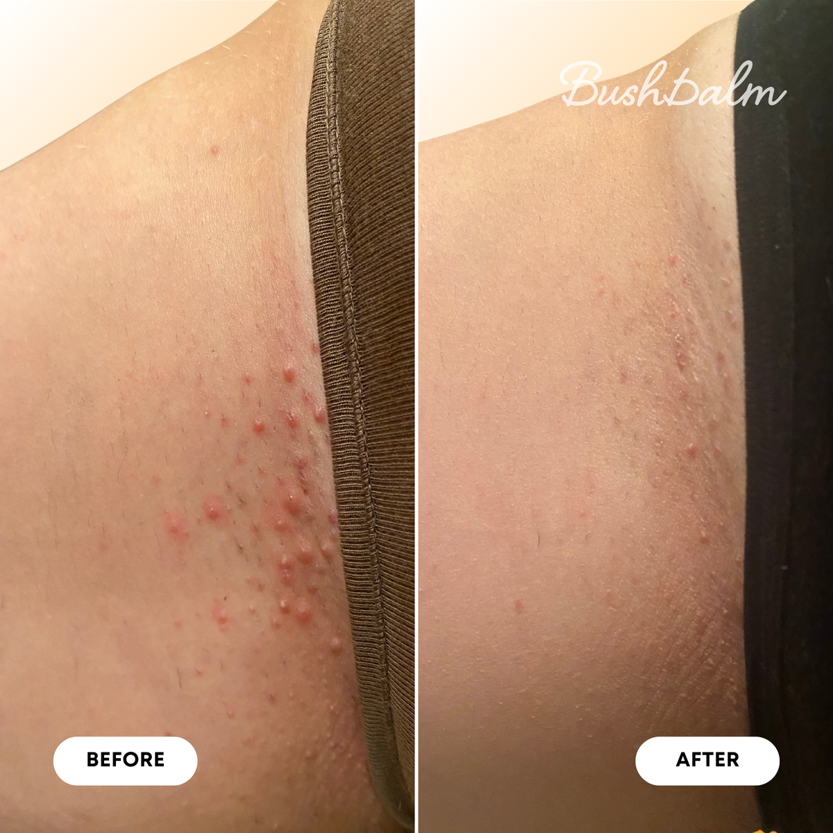 Ingrown Hair Oil - Vanilla Tangerine