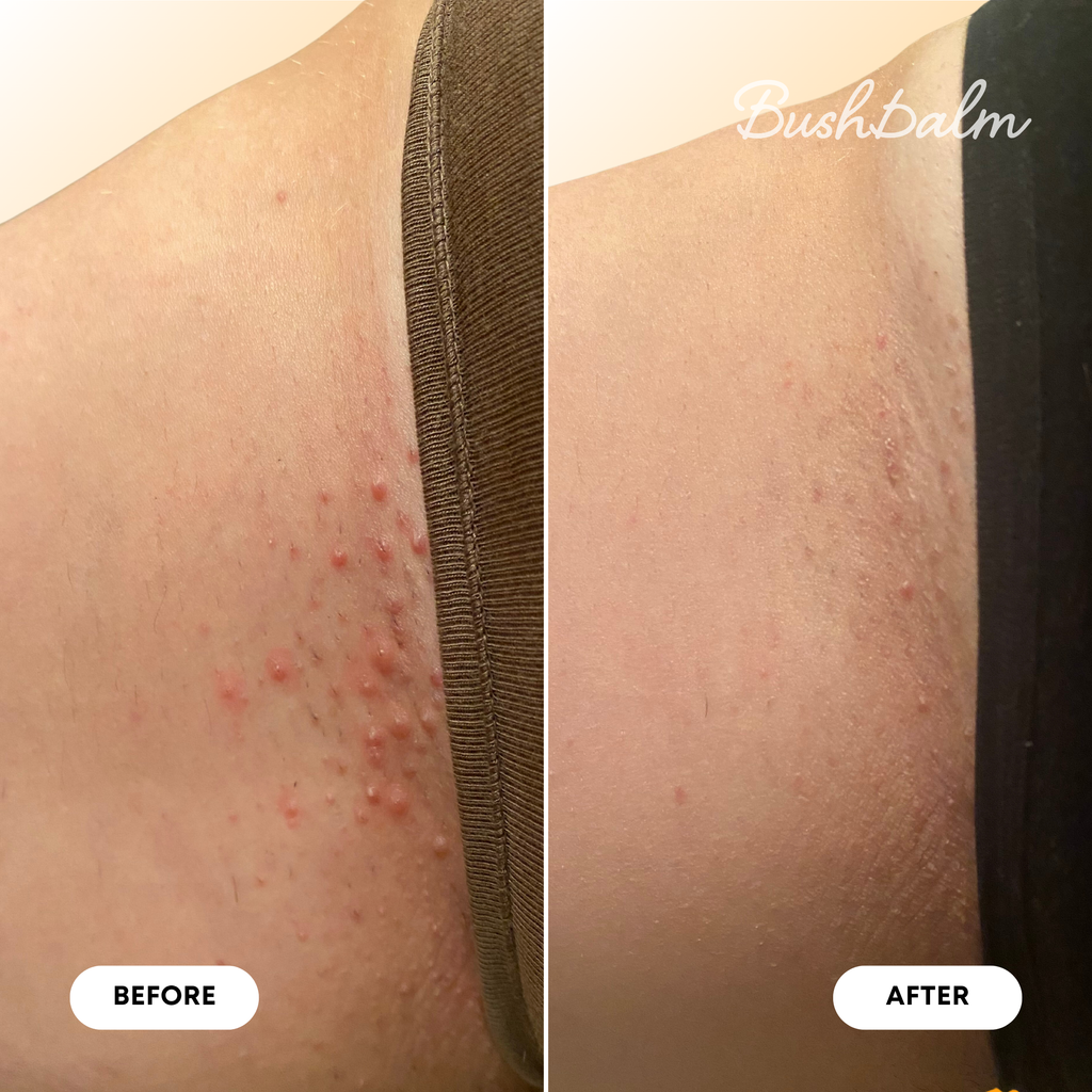 Mini Ingrown Hair Oil - Vanilla Tangerine